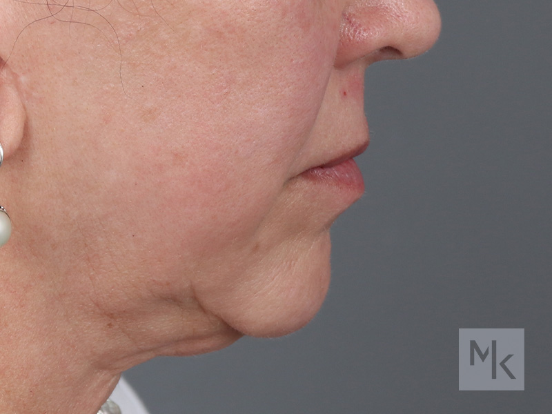 Lip Lift Before and After | Dr. Michael Kim