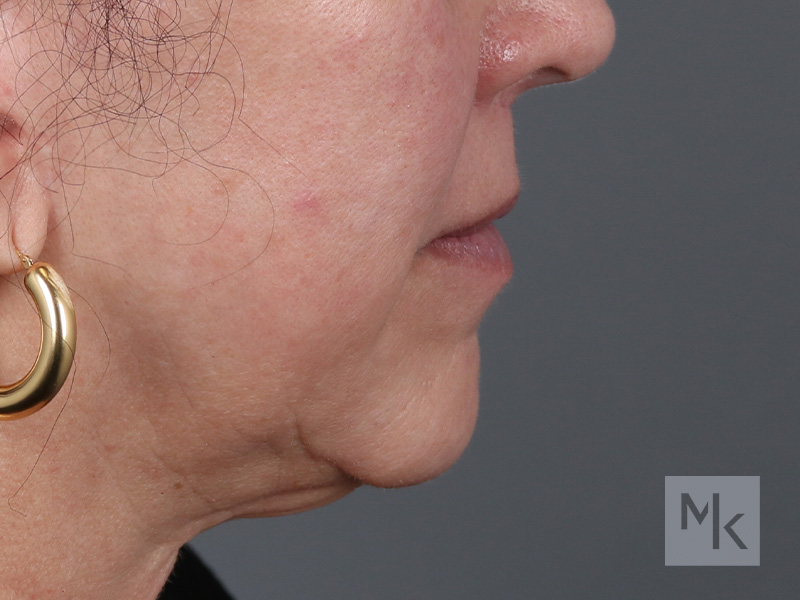 Lip Lift Before and After | Dr. Michael Kim