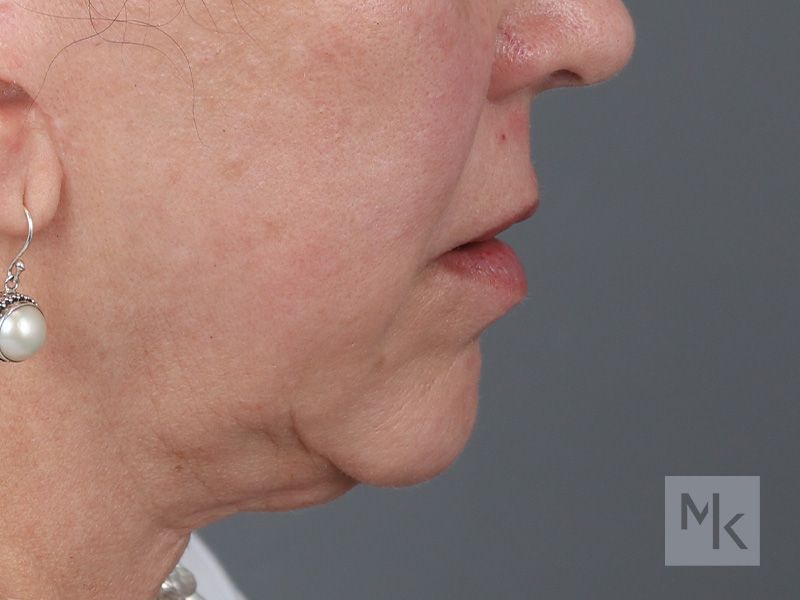 Lip Lift Before and After | Dr. Michael Kim