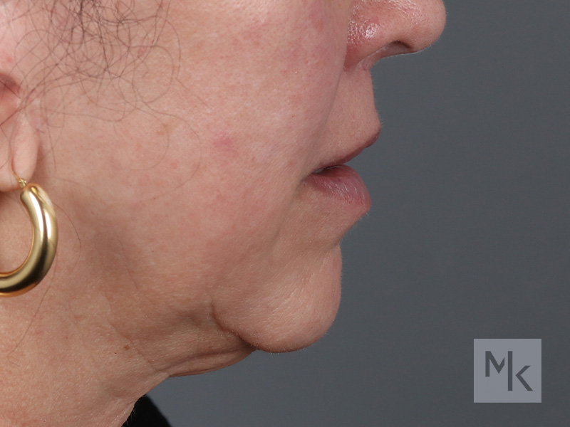 Lip Lift Before and After | Dr. Michael Kim