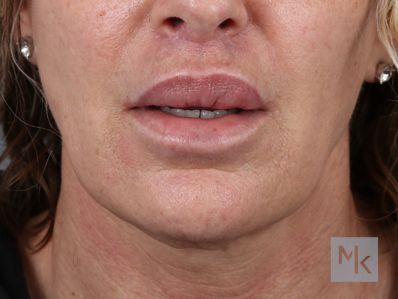 Lip Lift Before and After | Dr. Michael Kim