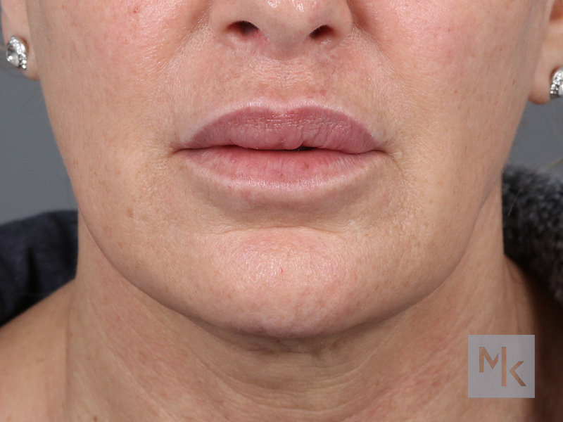 Lip Lift Before and After | Dr. Michael Kim