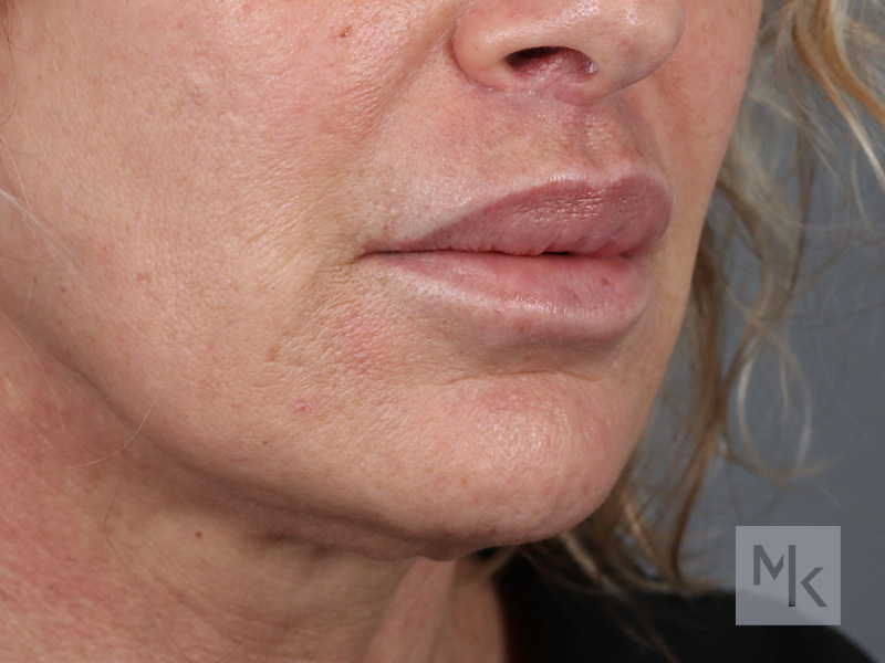 Lip Lift Before and After | Dr. Michael Kim