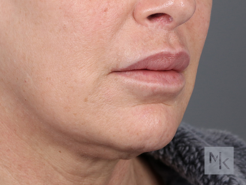 Lip Lift Before and After | Dr. Michael Kim