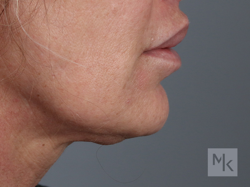 Lip Lift Before and After | Dr. Michael Kim