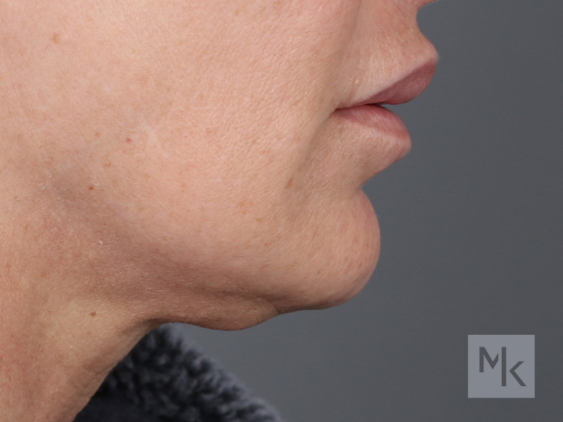 Lip Lift Before and After | Dr. Michael Kim