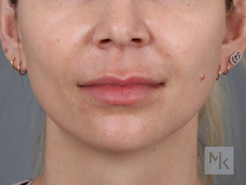 Lip Lift Before and After | Dr. Michael Kim