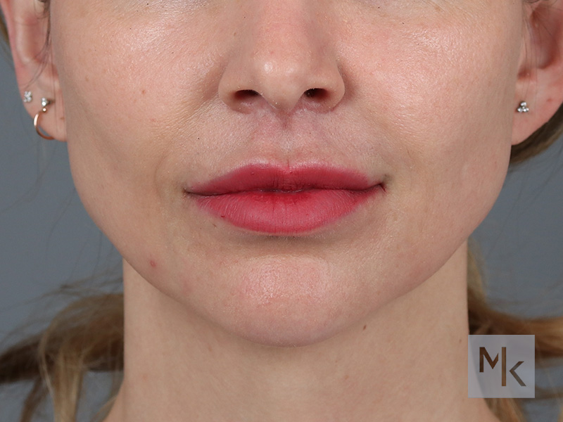 Lip Lift Before and After | Dr. Michael Kim