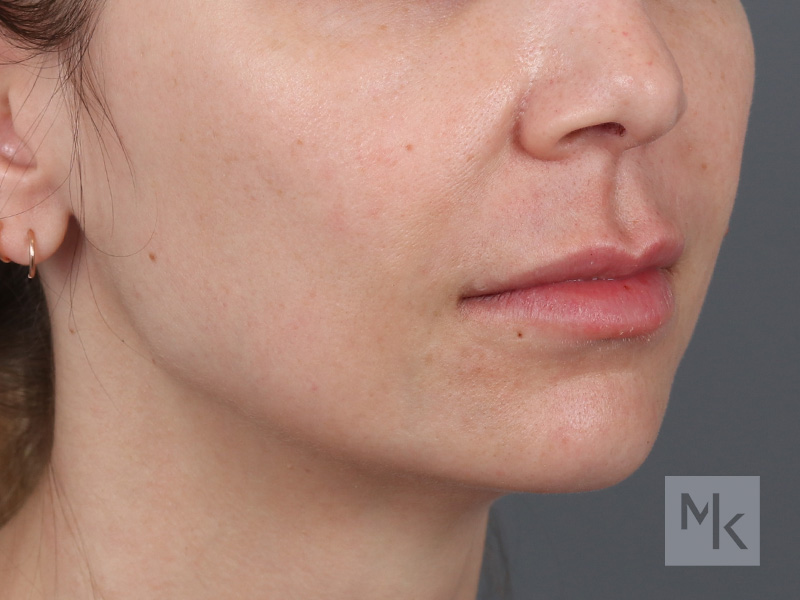 Lip Lift Before and After | Dr. Michael Kim