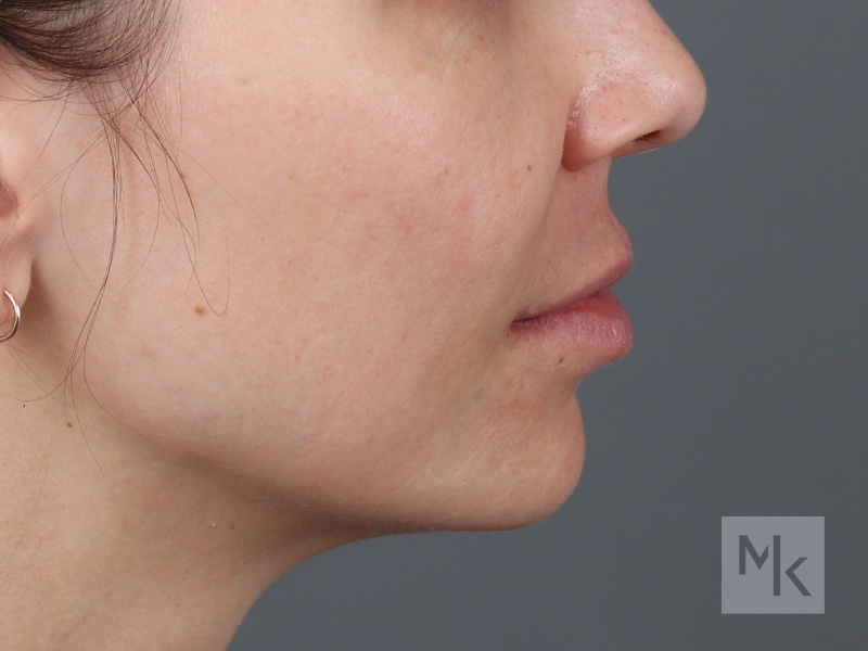 Lip Lift Before and After | Dr. Michael Kim