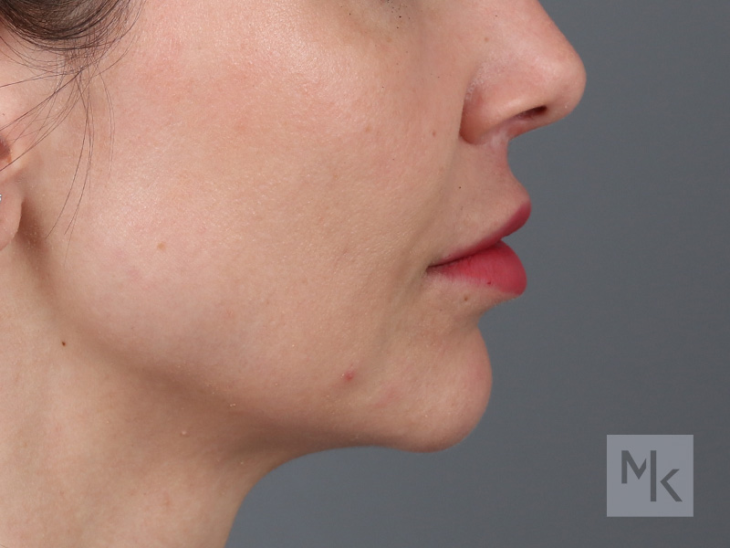 Lip Lift Before and After | Dr. Michael Kim