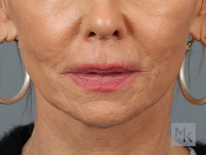 Lip Lift Before and After | Dr. Michael Kim