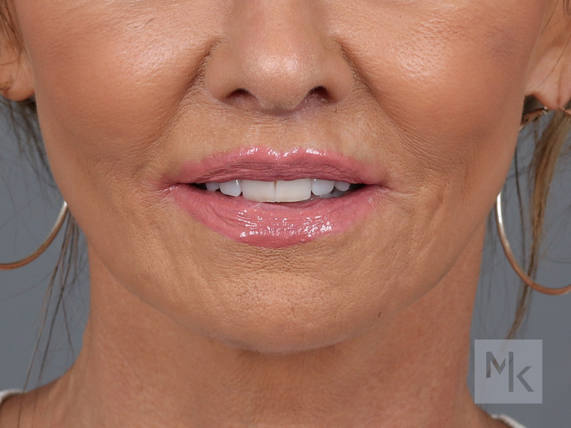 Lip Lift Before and After | Dr. Michael Kim