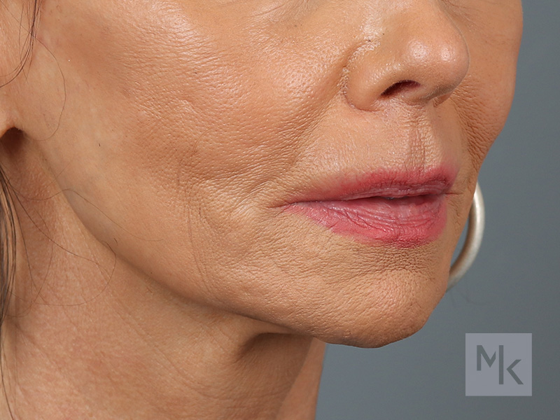 Lip Lift Before and After | Dr. Michael Kim