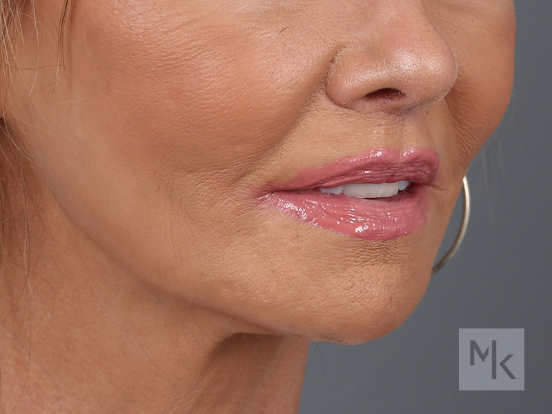 Lip Lift Before and After | Dr. Michael Kim