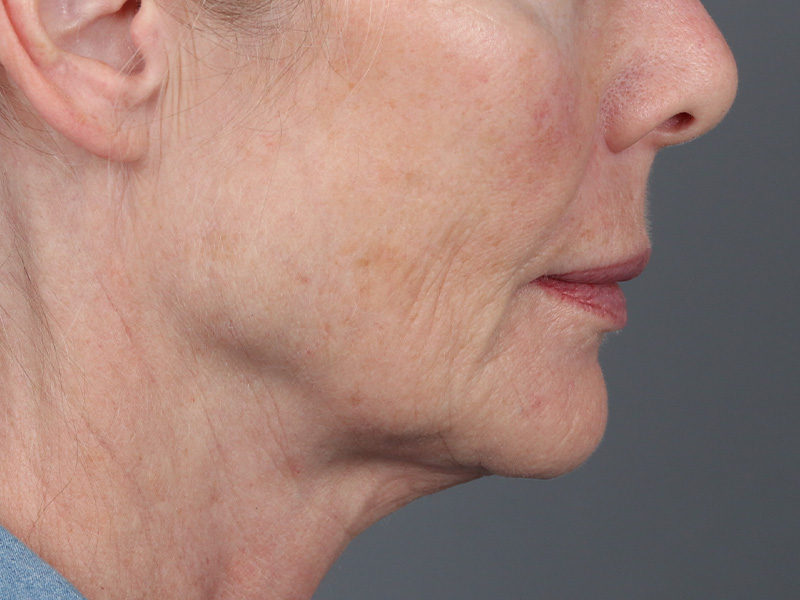 Lip Lift Before and After | Dr. Michael Kim