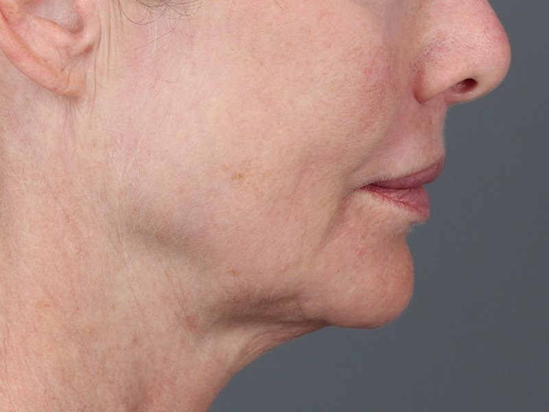 Lip Lift Before and After | Dr. Michael Kim