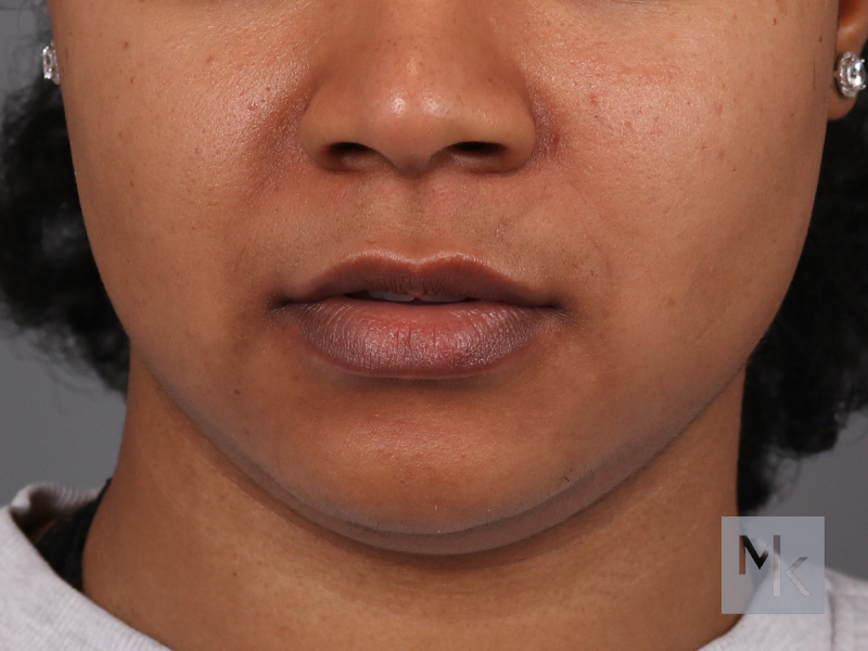 Lip Lift Before and After | Dr. Michael Kim