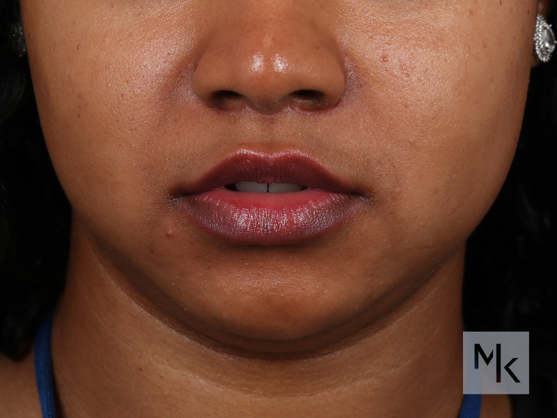 Lip Lift Before and After | Dr. Michael Kim