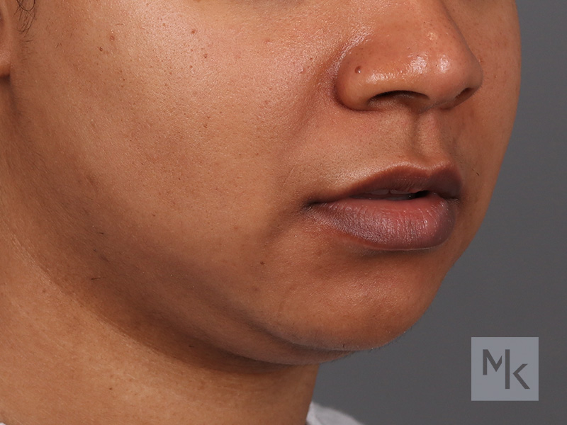 Lip Lift Before and After | Dr. Michael Kim