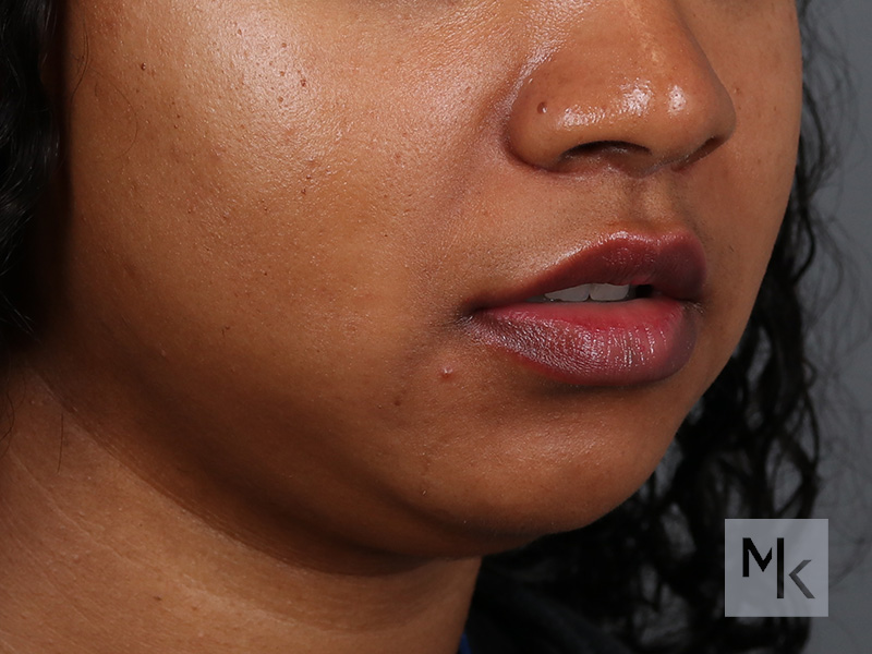 Lip Lift Before and After | Dr. Michael Kim