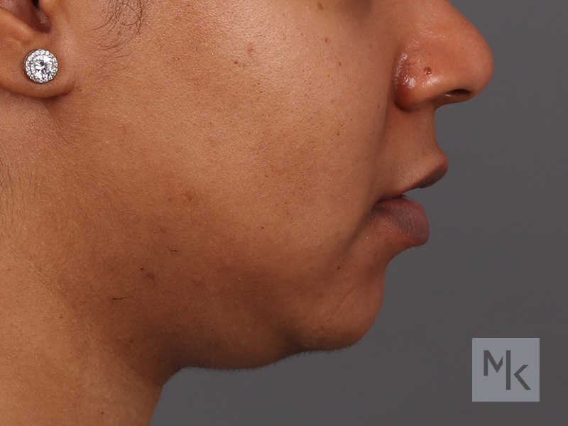 Lip Lift Before and After | Dr. Michael Kim