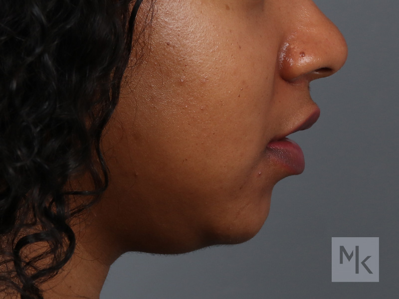 Lip Lift Before and After | Dr. Michael Kim