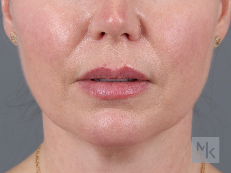 Lip Lift Before and After | Dr. Michael Kim