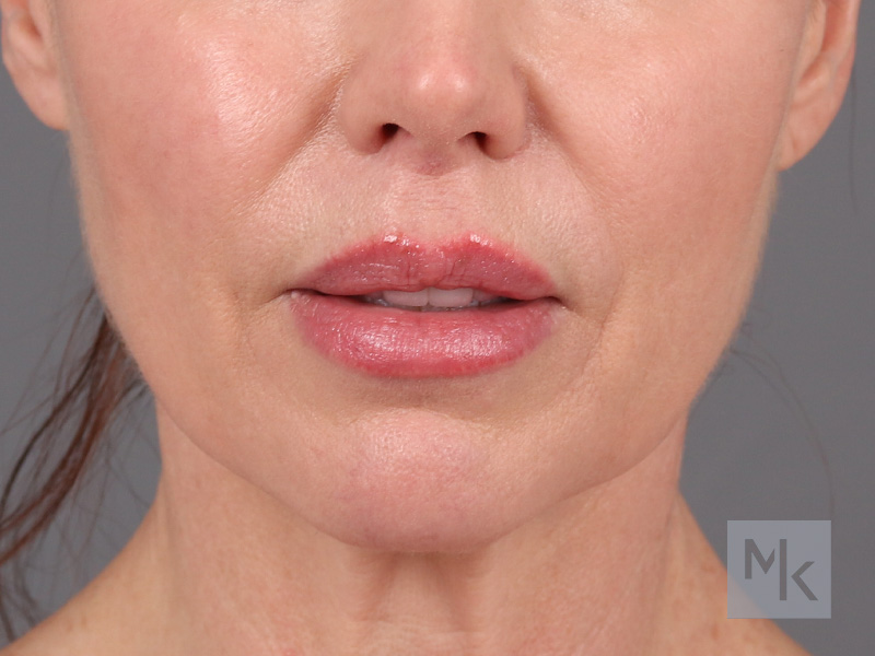 Lip Lift Before and After | Dr. Michael Kim