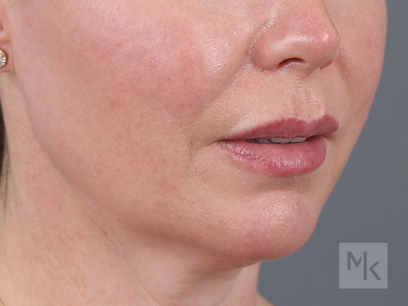 Lip Lift Before and After | Dr. Michael Kim