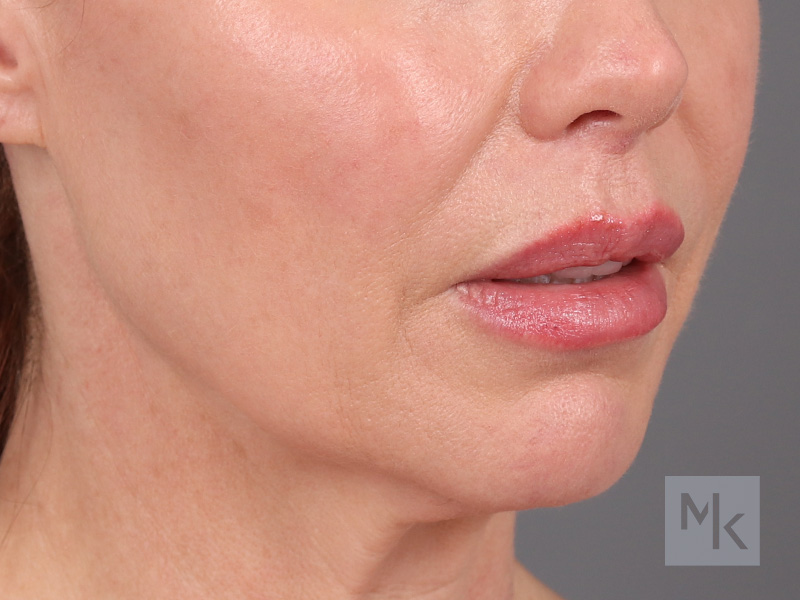 Lip Lift Before and After | Dr. Michael Kim