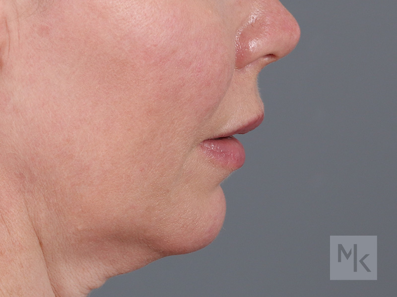 Lip Lift Before and After | Dr. Michael Kim