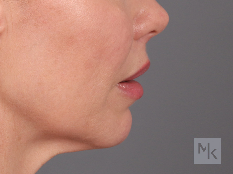 Lip Lift Before and After | Dr. Michael Kim