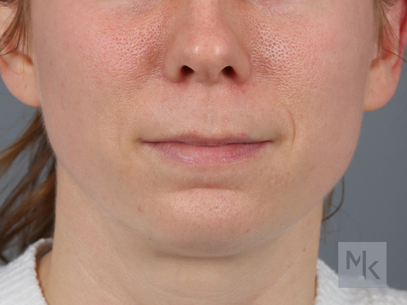 Lip Lift Before and After | Dr. Michael Kim