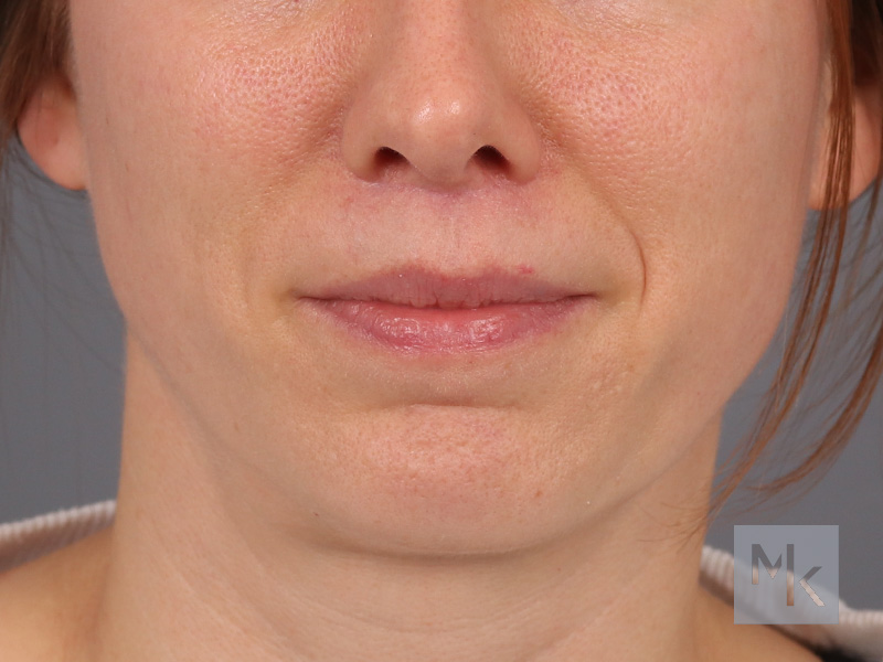 Lip Lift Before and After | Dr. Michael Kim