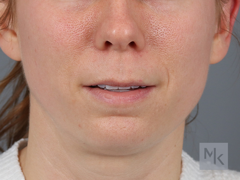 Lip Lift Before and After | Dr. Michael Kim