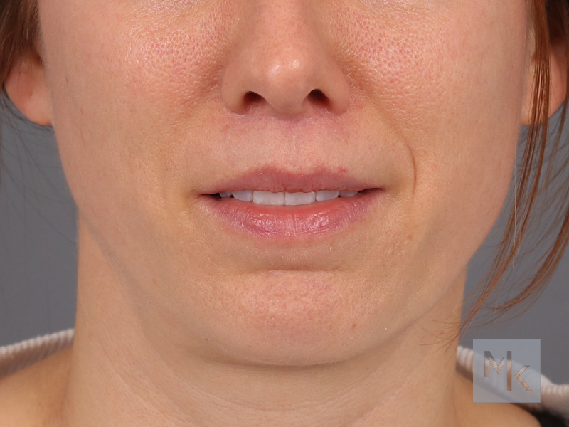 Lip Lift Before and After | Dr. Michael Kim