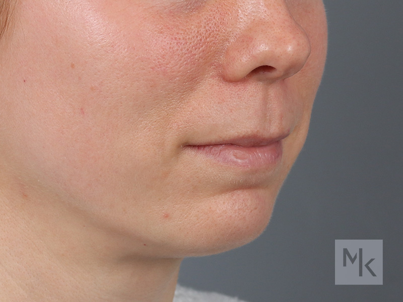 Lip Lift Before and After | Dr. Michael Kim