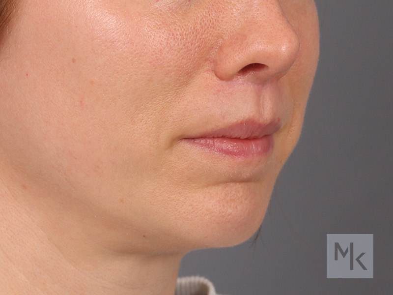 Lip Lift Before and After | Dr. Michael Kim