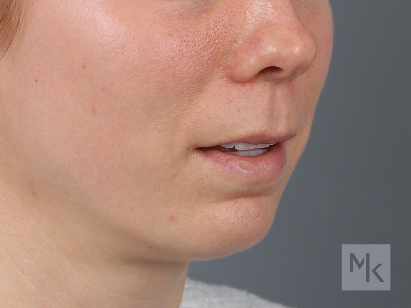 Lip Lift Before and After | Dr. Michael Kim