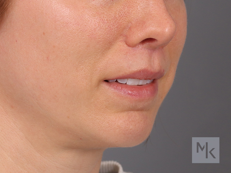 Lip Lift Before and After | Dr. Michael Kim