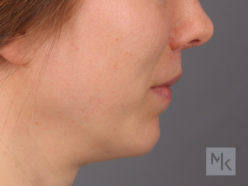 Lip Lift Before and After | Dr. Michael Kim