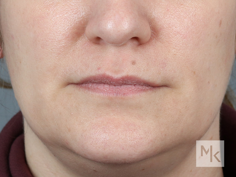 Lip Lift Before and After | Dr. Michael Kim