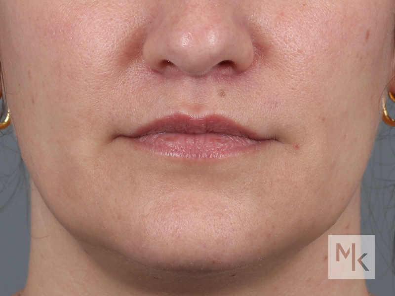 Lip Lift Before and After | Dr. Michael Kim