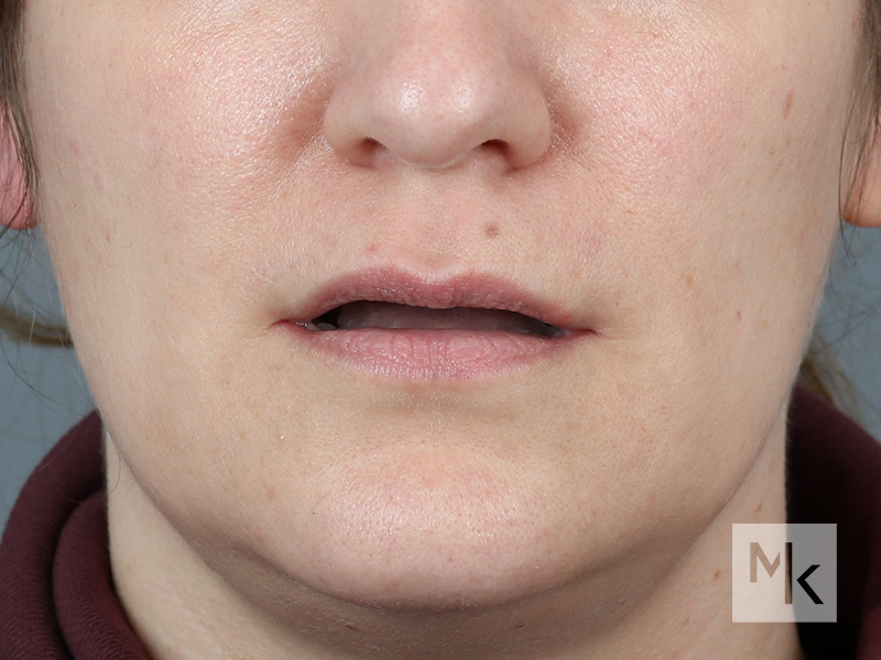 Lip Lift Before and After | Dr. Michael Kim