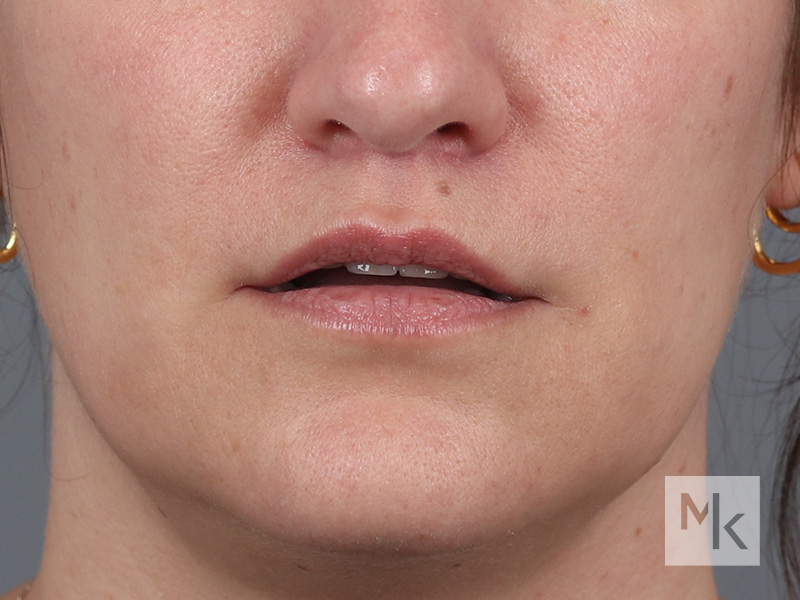 Lip Lift Before and After | Dr. Michael Kim