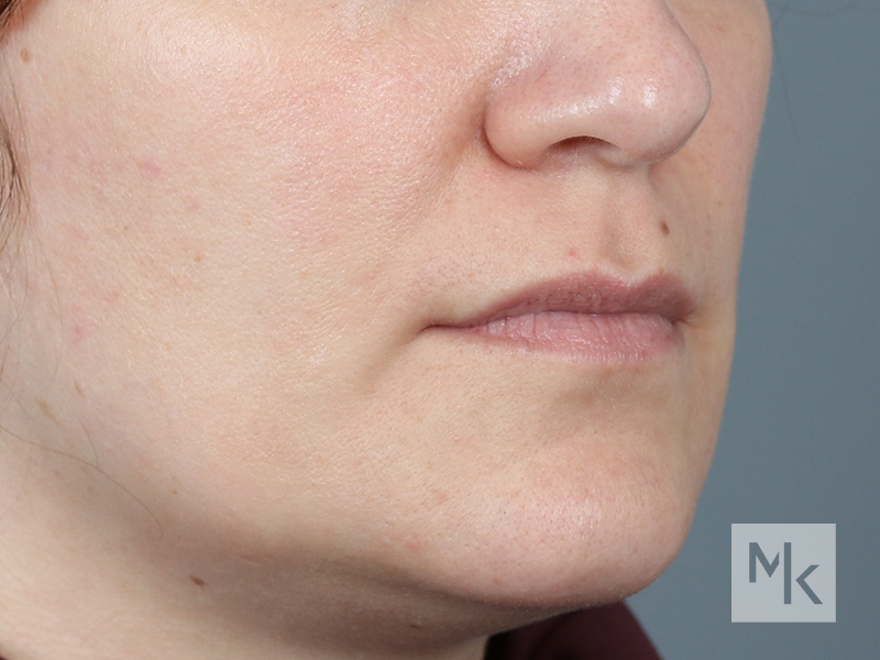 Lip Lift Before and After | Dr. Michael Kim