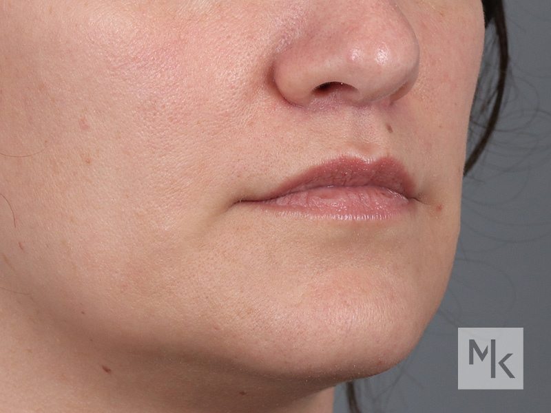 Lip Lift Before and After | Dr. Michael Kim