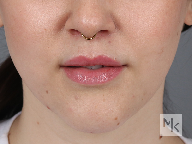 Lip Lift Before and After | Dr. Michael Kim