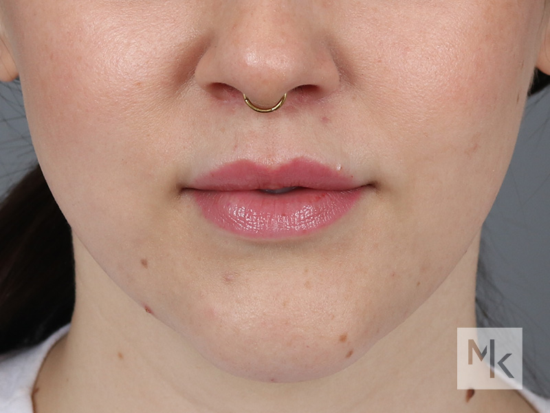 Lip Lift Before and After | Dr. Michael Kim